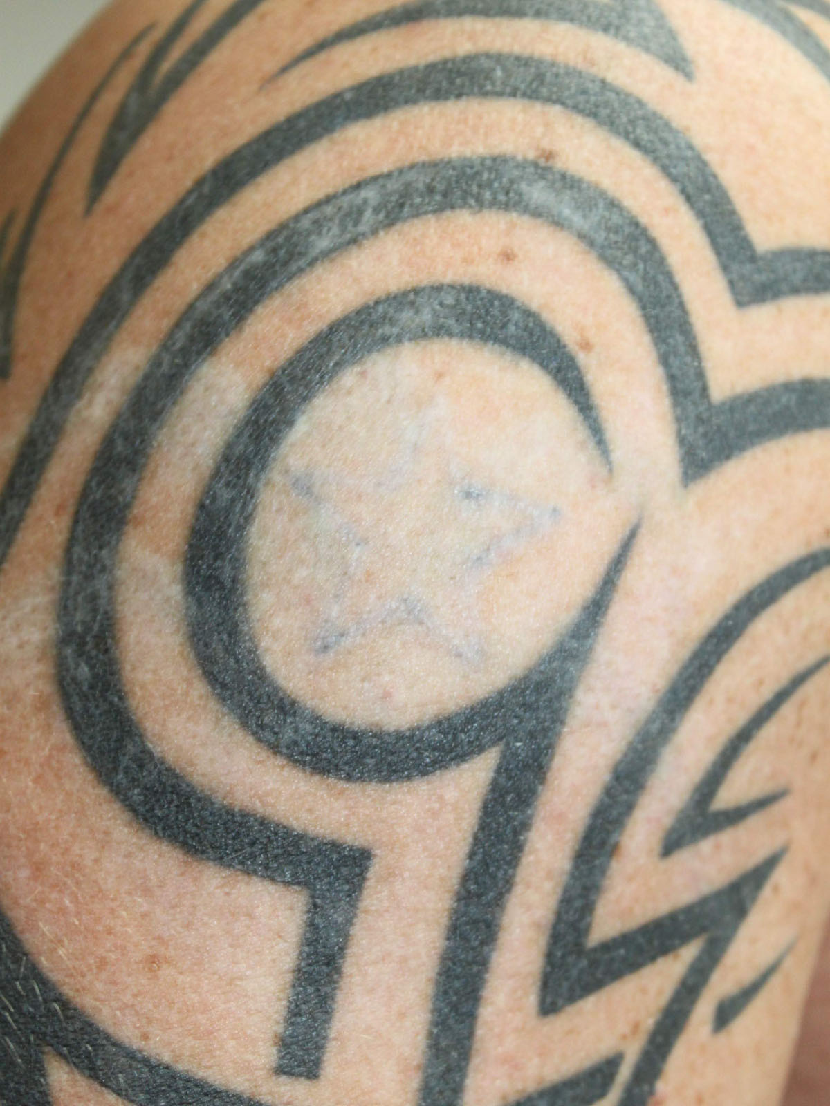 Tattooentfernung am Oberarm mach 11 Behandlungen