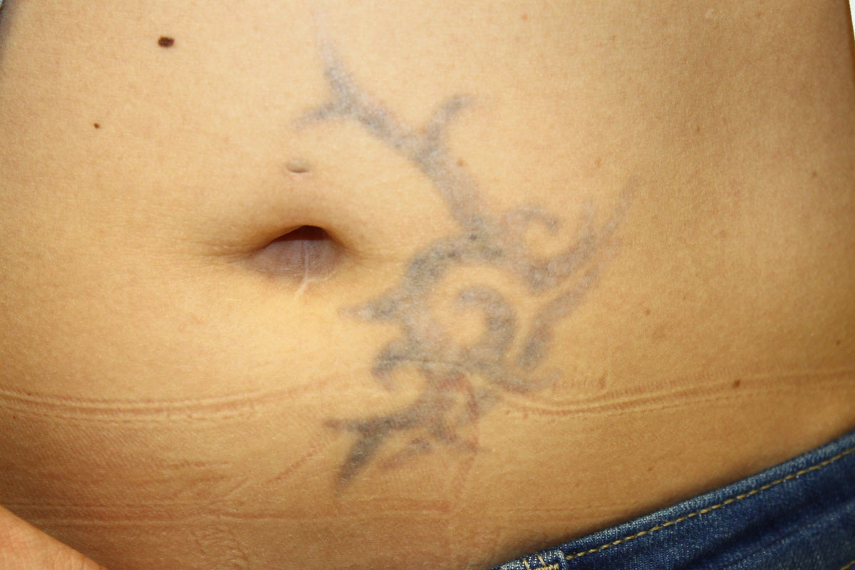 Tattooentfernung am Bauch nach 4 Behandlungen