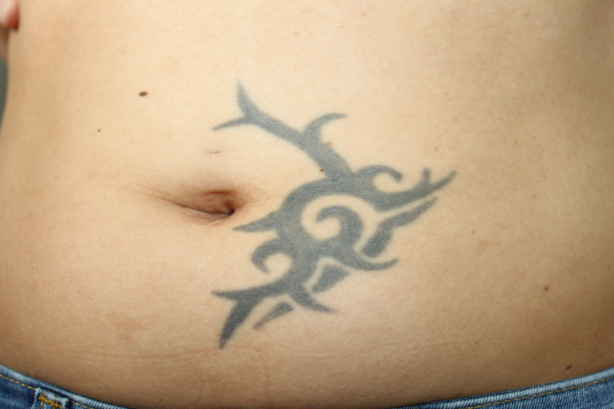Tattooentfernung am Bauch vor der Behandlung