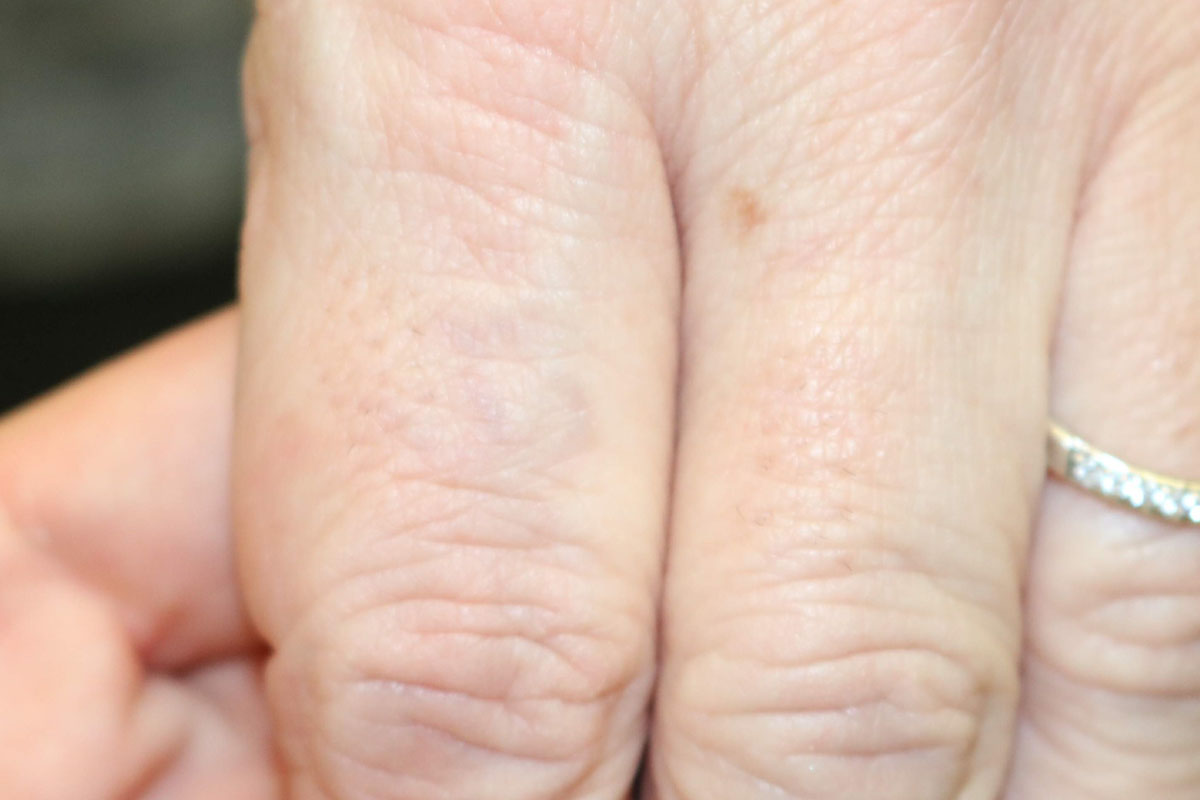 Tattooentfernung am Finger nach 14 Behandlungen