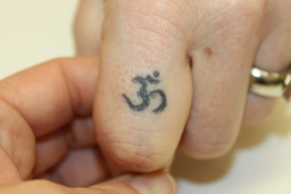Tattooentfernung am Finger vor der Behandlung