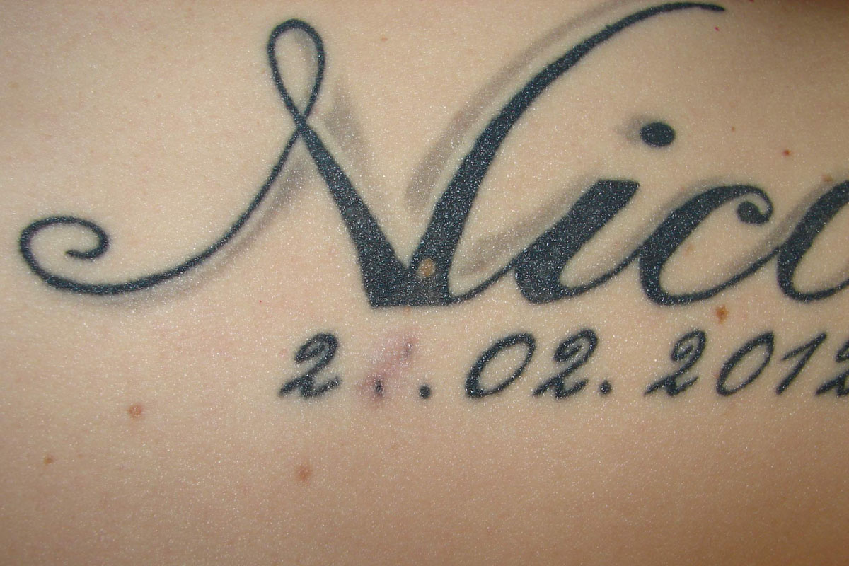 Vernarbt tattoo Tattoo removal