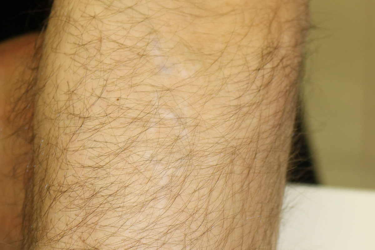 Tattooentfernung einer Tätowierung am Unterarm nach 16 Behandlungen